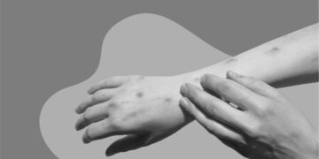 منکی پوکس وائرس اتنی تیزی سے کیوں پھیل رہا ہے اور کیا اس کی ویکسین موجود ہے؟